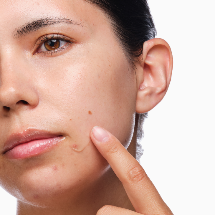 The Acne Set: Salicylic Acid 2% Regimen for Clear Skin 1 set - Image 3